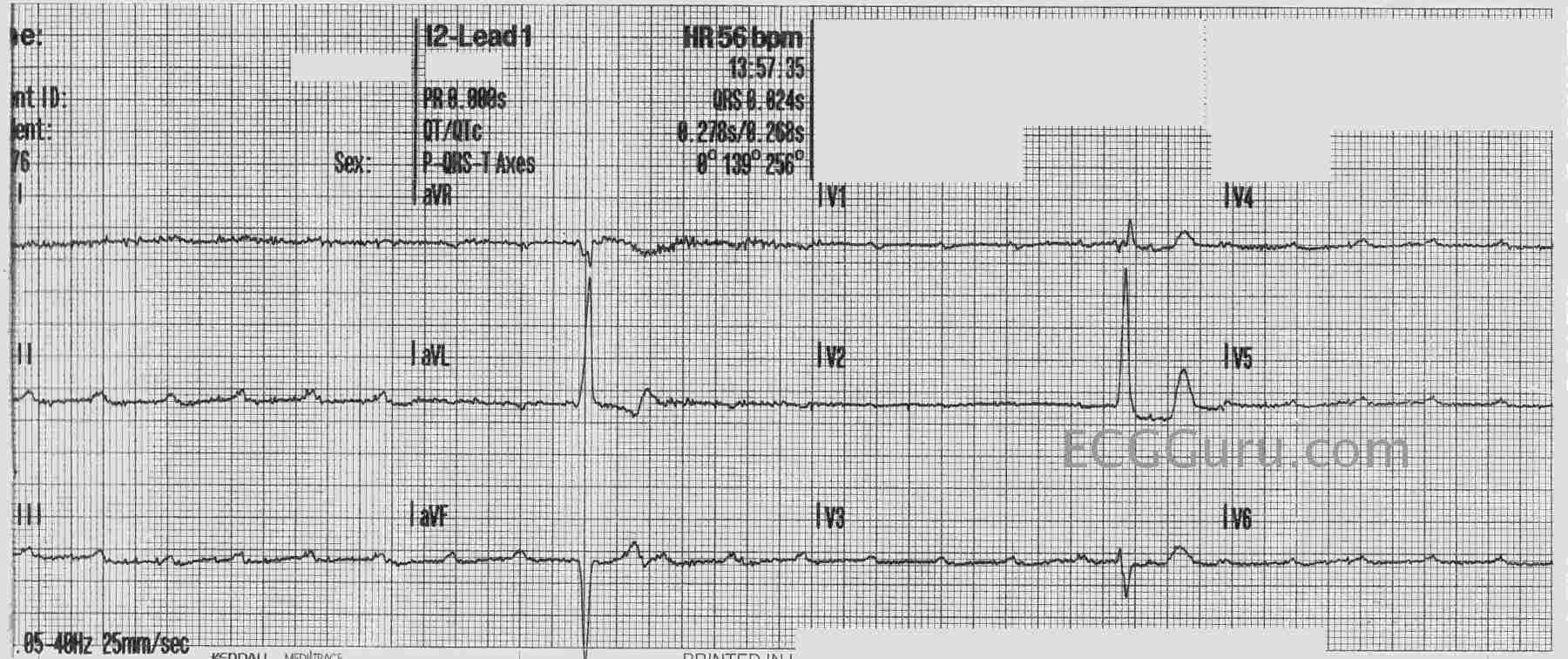 complete-heart-block-ecg-guru-instructor-resources